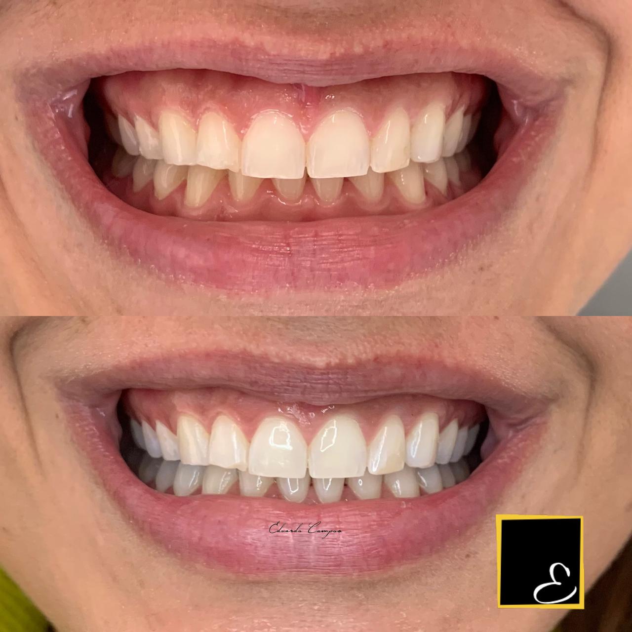 Caso real de clareamento dental - Débora