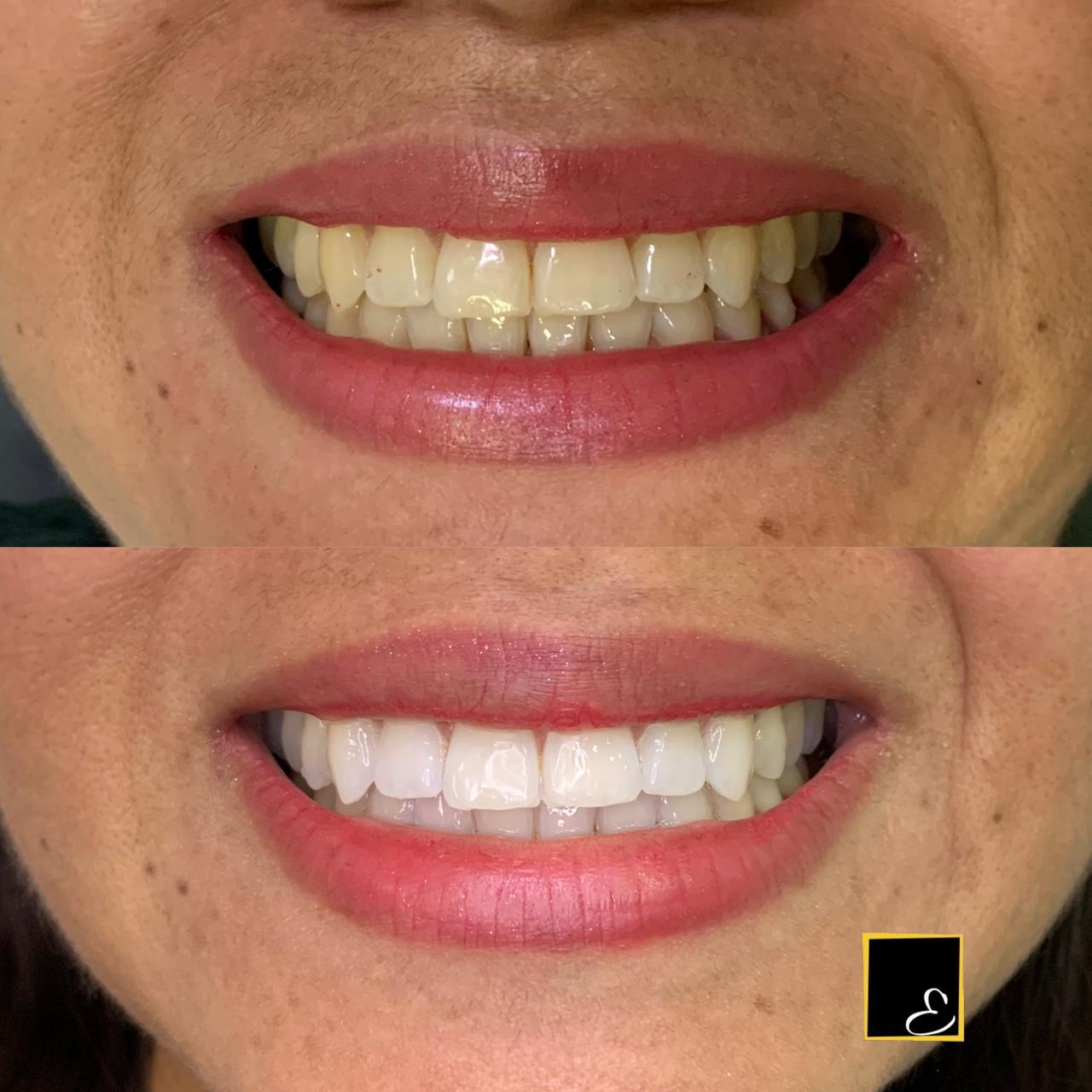 Caso real de clareamento dental - Edivanira