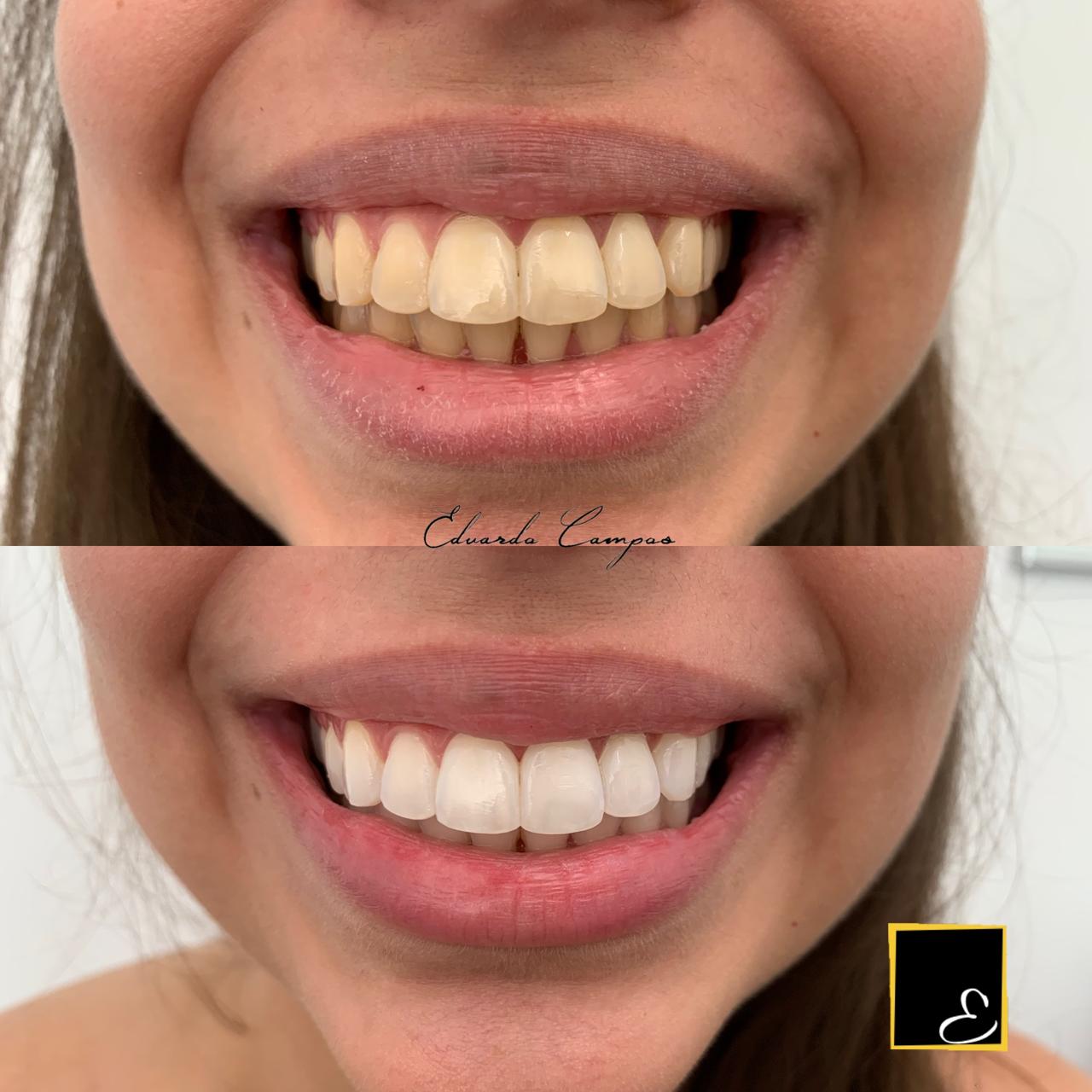 Caso real de clareamento dental - Jéssica